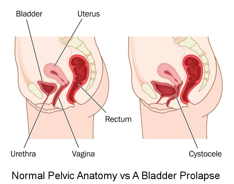 An illustration showing normal female abdominal anatomy and a prolapsed bladder.
